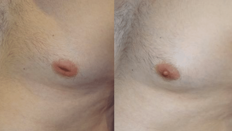 male inverted nipple correction before after 4
