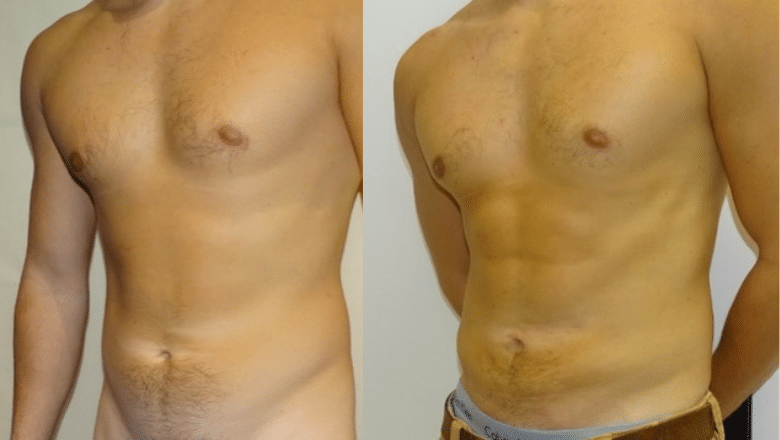 male liposuction before after 3