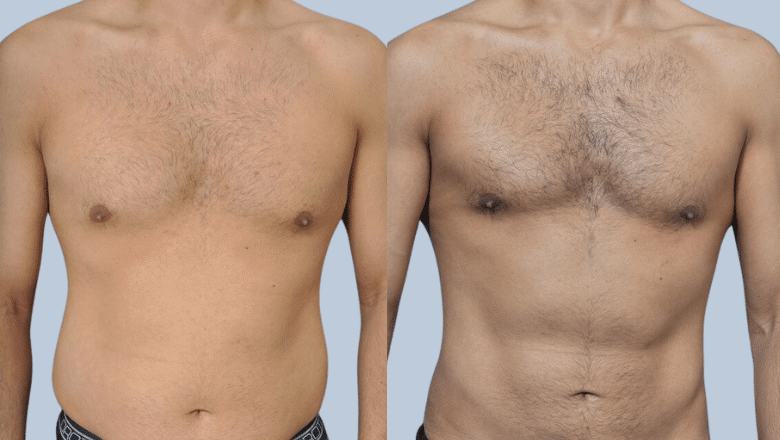 male liposuction before and after 7