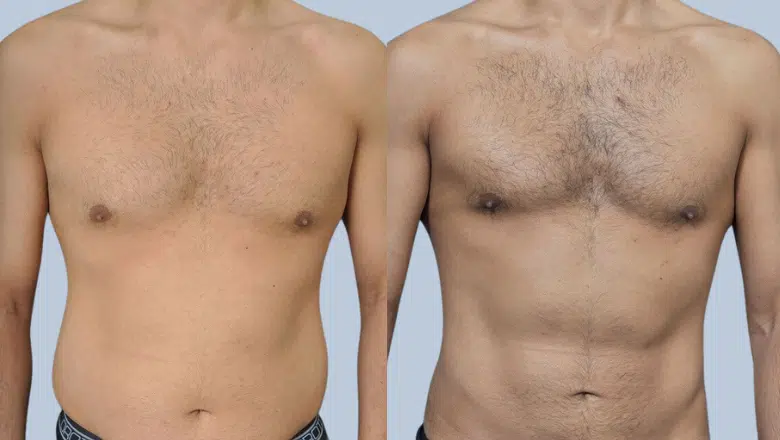 male liposuction before and after 7