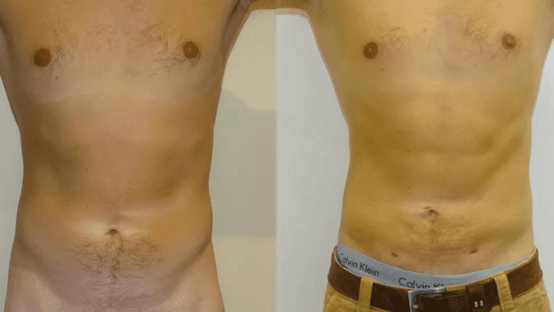 male stomach lipo before and after