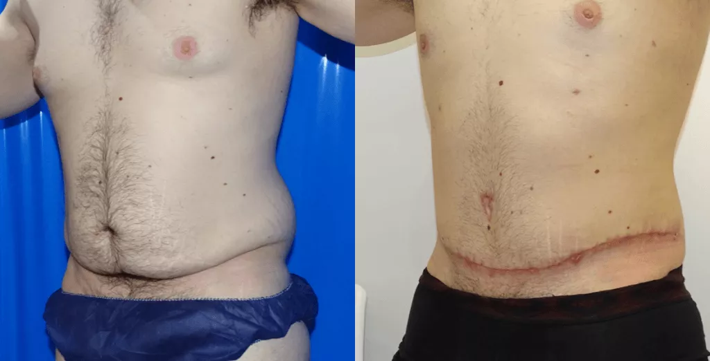Male Abdominoplasty London  Tummy Tuck for Men  Centre for Surgery