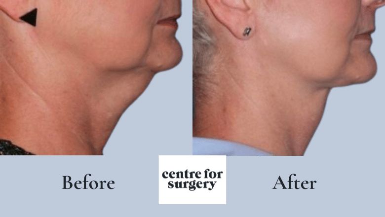 neck lift before after 1