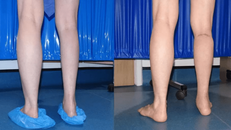 right calf augmentation implants before after 5