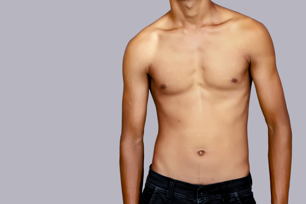 mild concave chest