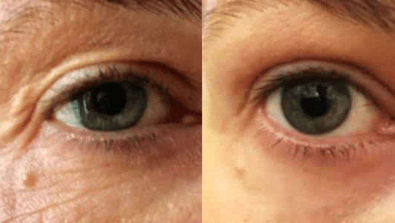 smootheye non surgical eye lift before after 2