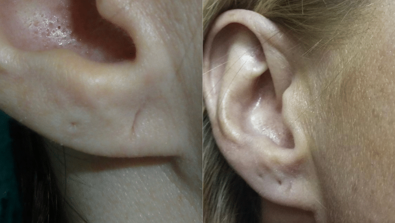 split earlobe repair before and after 6