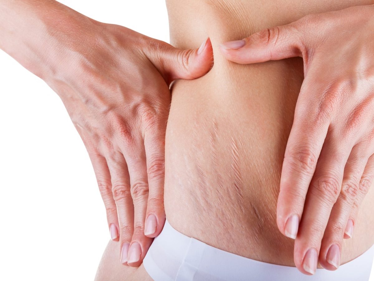Stretch Mark Removal London | Surgery to Remove Stetch Marks London Near Me