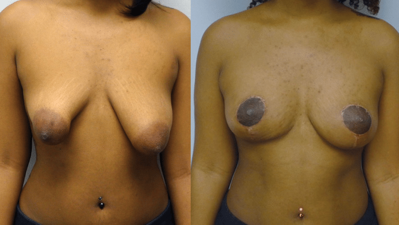 breast asymmetry correction before after 2