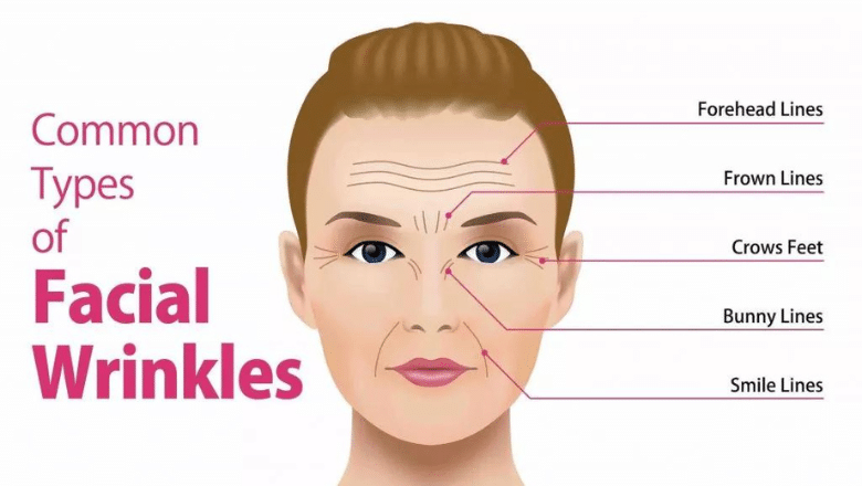 anti wrinkle injections near me