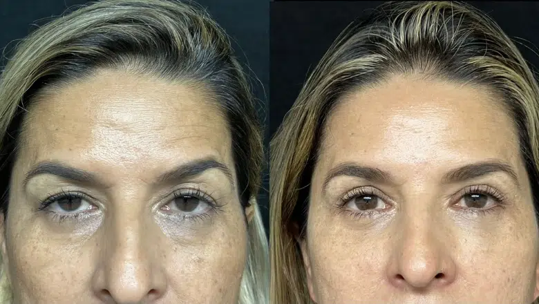 upper eyelid lift before after