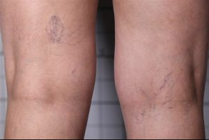 spider vein microsclerotherapy before