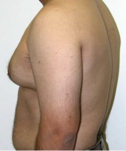 liposuction male breast reduction before