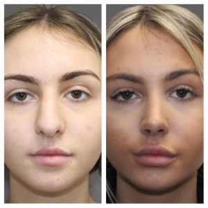 Rhinoplasty London Nose Job London Rhinoplasty Cost London