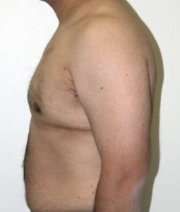 liposuction male breast reduction after