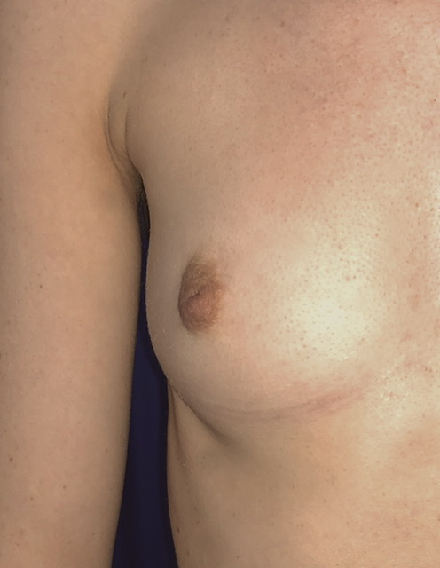 right sided inverted nipple correction before