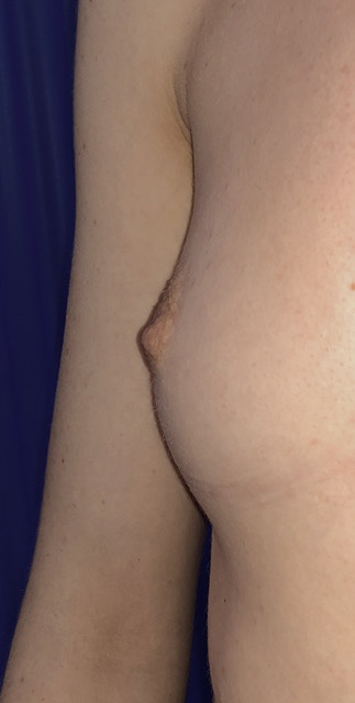 inverted nipple correction before