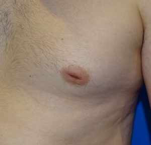 male inverted nipple correction before