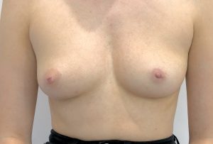 left sided inverted nipple correction after