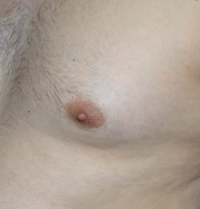 male inverted nipple correction after
