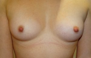 bilateral inverted nipple correction after