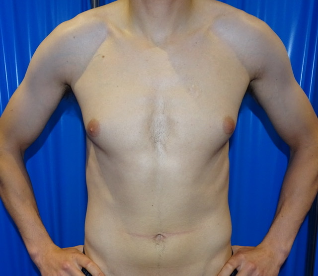 male breast reduction puffy nipples before