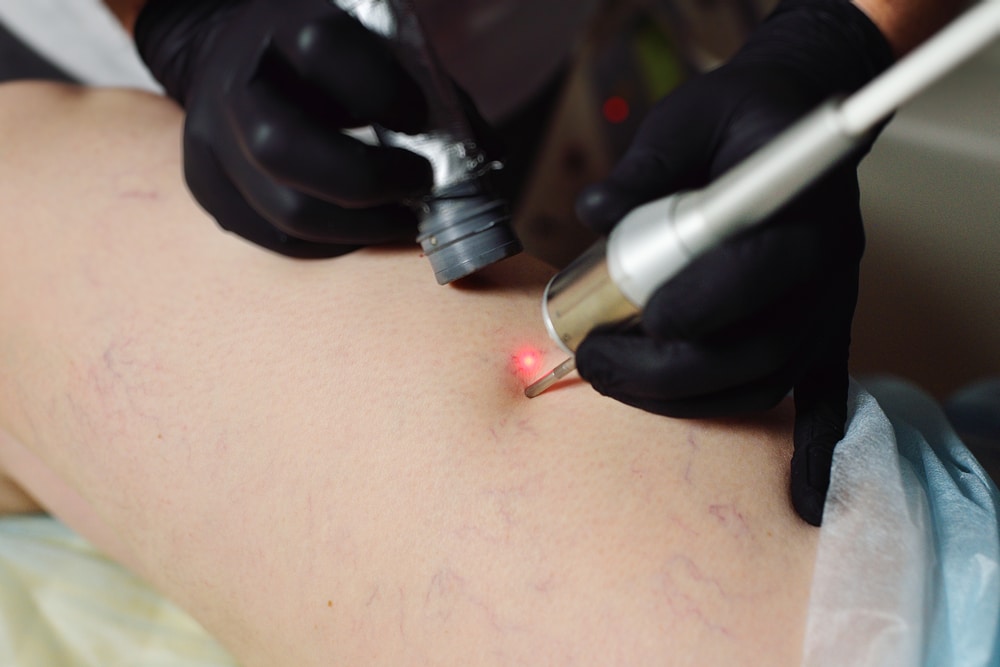 laser thread vein removal