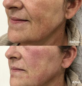 laser skin tightening of face before and after
