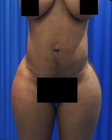 liposuction abdomen and flanks after