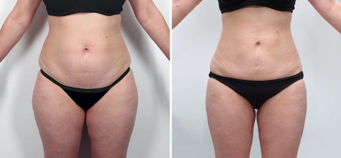 abdominal liposuction before and after