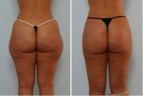 liposuction saddlebags before and after