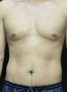high definition liposuction abdomen before