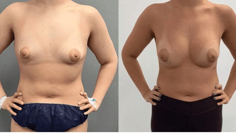 tuberous breast correction before and after