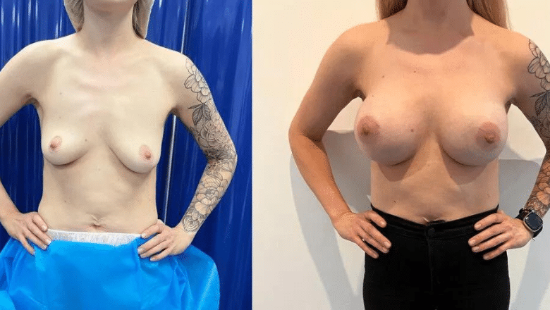 boob job London before and after