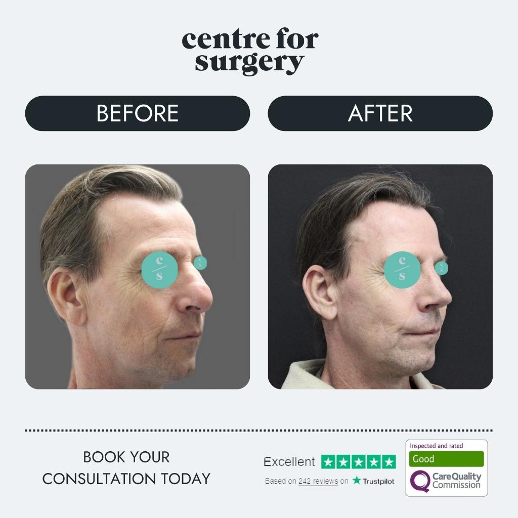 male rhinoplasty before and after centre for surgery