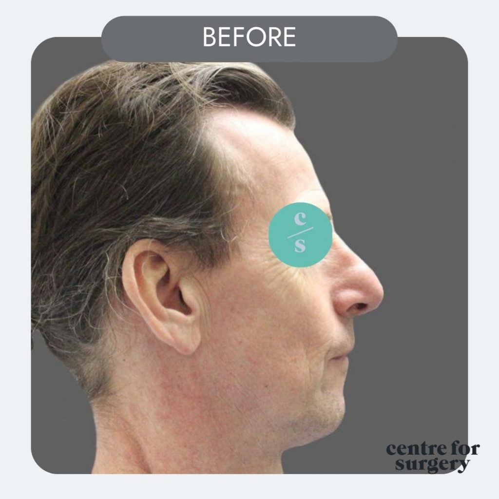 revision rhinoplasty profile view before