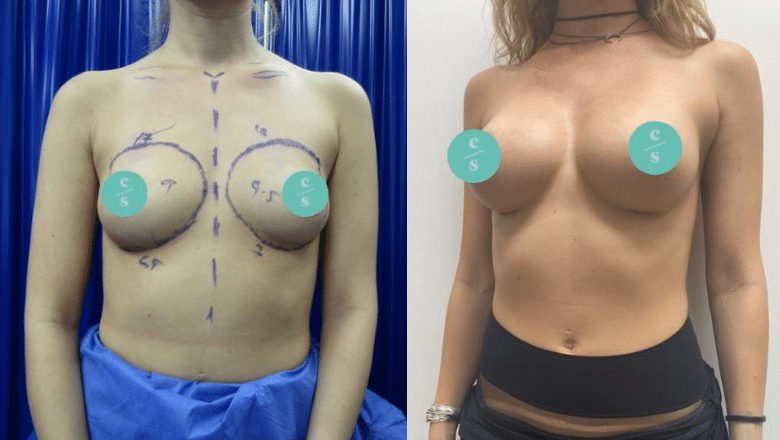 breast augmentation before after 10
