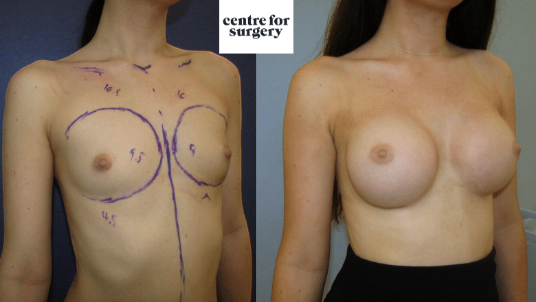 breast augmentation before after 17 (2)
