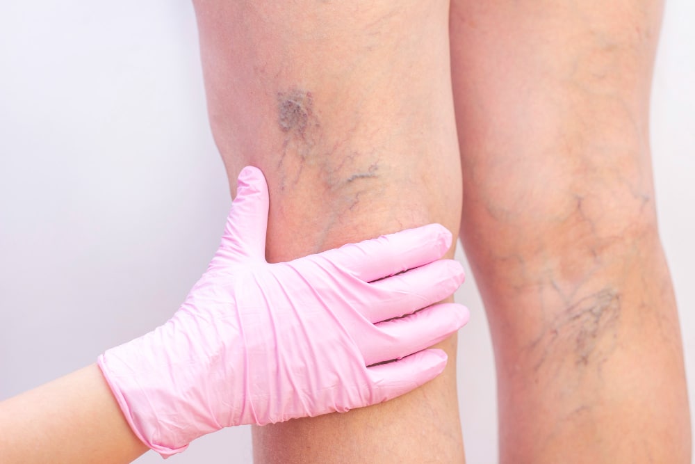 best varicose vein removal treatments in London