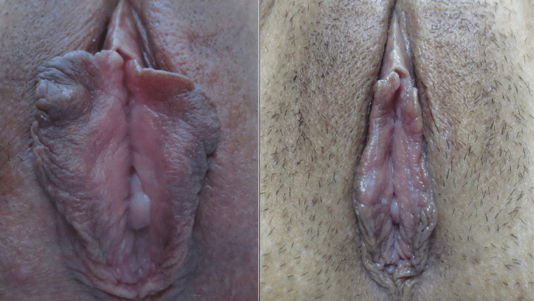 labia reduction before after 2