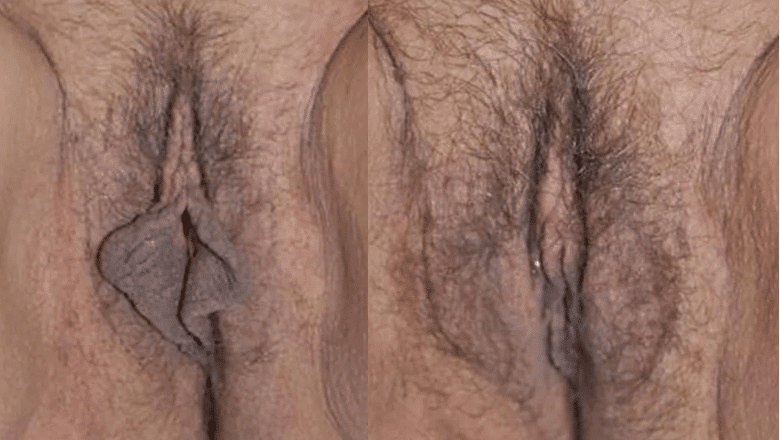 labia reduction surgery before after 3