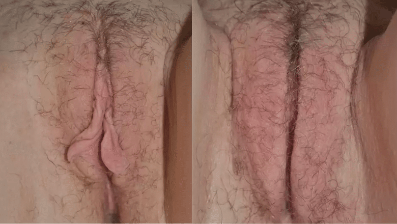 labiaplasty surgery before after 8