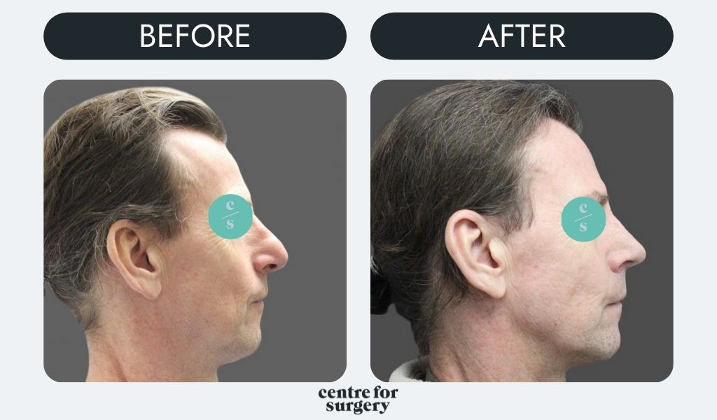 male rhinoplasty centre fior surgery before after