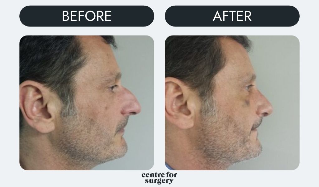male rhinoplasty nose job centre for surgery before after