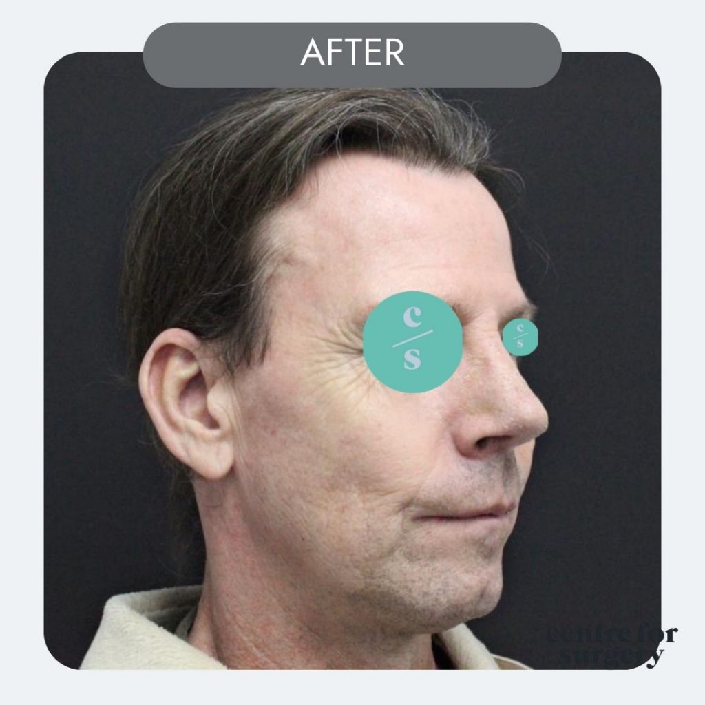 revision rhinoplasty oblique view after
