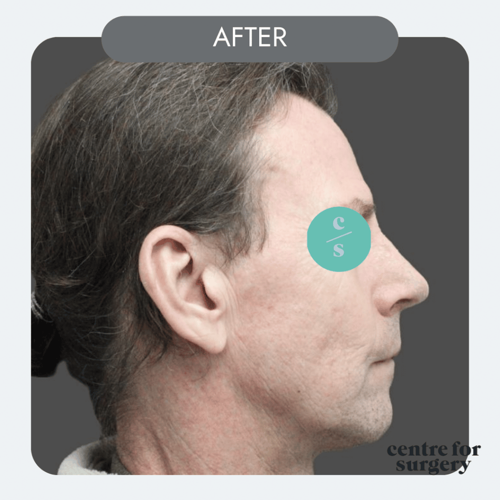 revision rhinoplasty profile view after