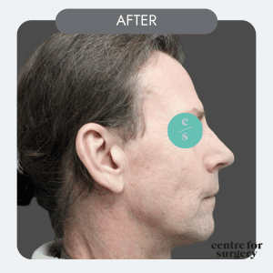 male rhinoplast before side afterprofile centre for surgery uk london