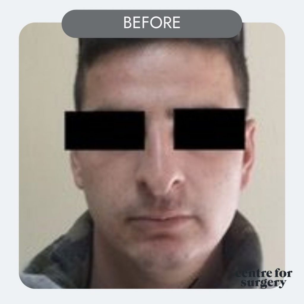 male rhinoplasty before side after profile centre for surgery uk london (2)