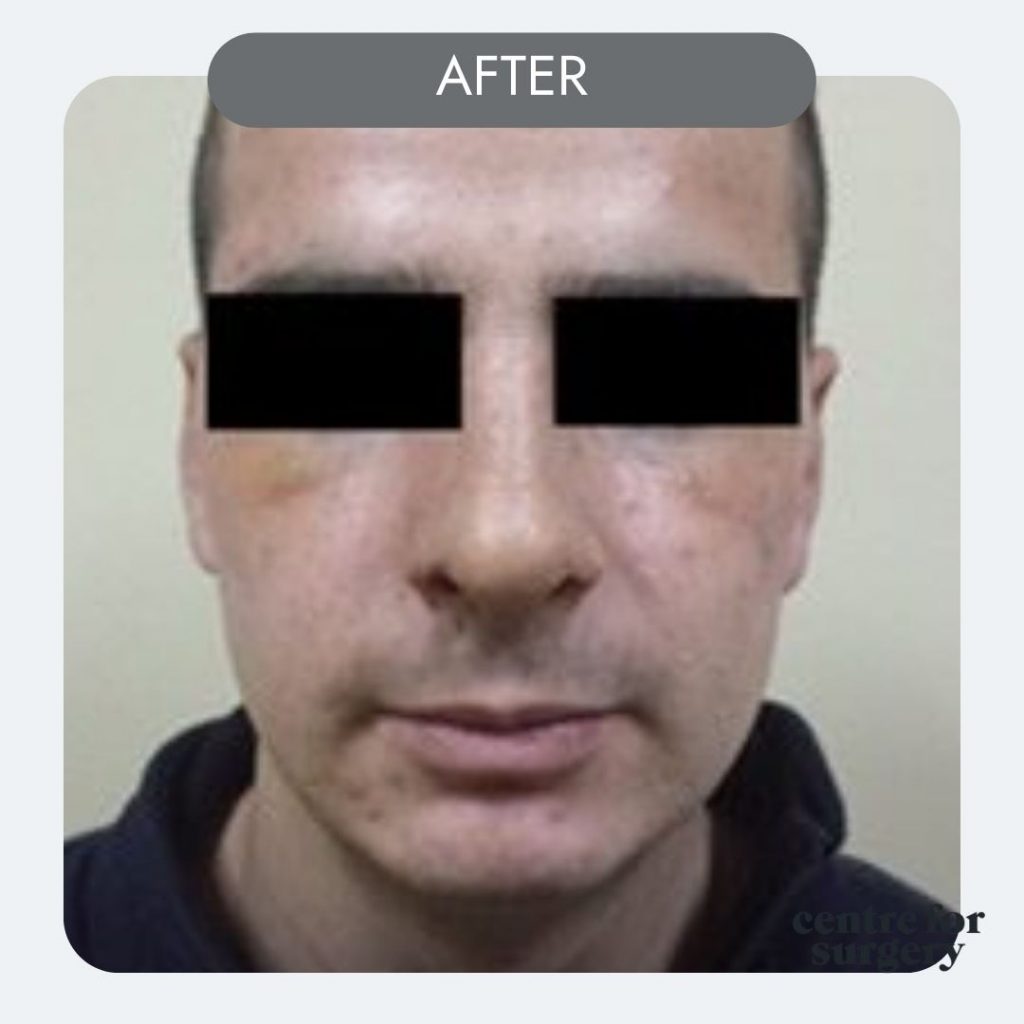 male rhinoplasty before side after profile centre for surgery uk london (2)