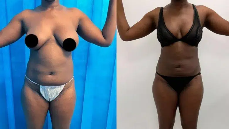 360 liposuction before and after